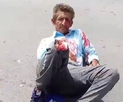 Two men suffered from two horrific leg injurie due to motorcycle crash