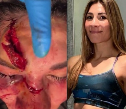 So u Wanna Fight MMA? Irene Aldana Face Deformed after Fight