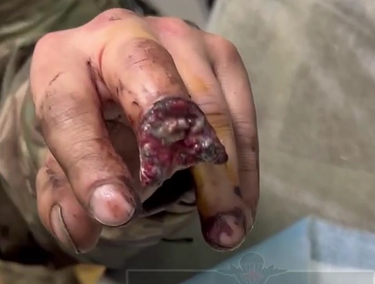 Russian soldier suffering a horrific fingers wounds 