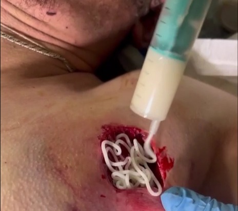 Russian soldier suffer a horrible injury hospitalized 