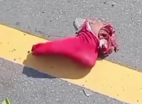 Motorcyclist lost his foot due to collision with truck 