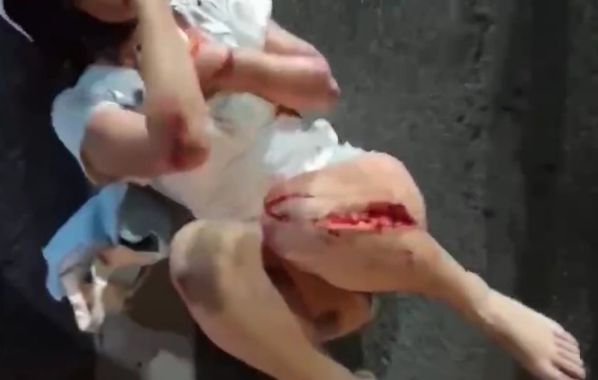 Horrific wound after girl on moped crashed by speeding car 