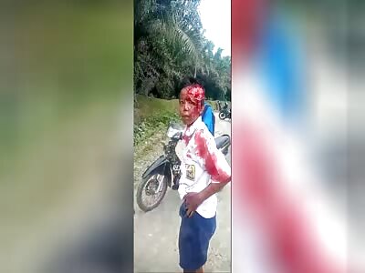 Brutal young man ends up with a torn scalp after an accident 