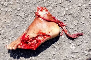 Decapitated foot after a horrific motorcycle accident 