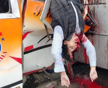 Horrific Collision between two bus leaves driver with empty skull 