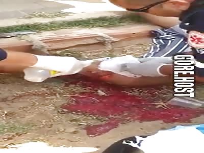 women bad leg injury after accident 