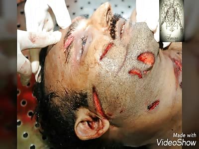 Multiple Stab Wounds by Knife