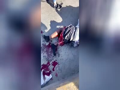 Man suffers terrible injury after motorcycle accident 