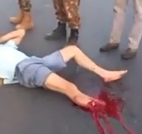 Biker's Foot Severed In Accident