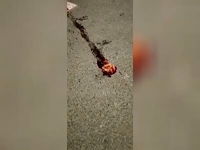 Man's Heart Beating Outside His Body