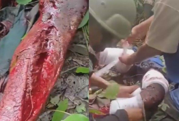 Myanmar Soldier Stepped On Landmine