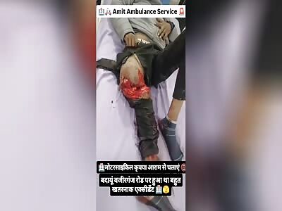 LEG DESTROYED IN AN ACCIDENT