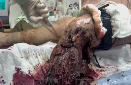 Wounded Russian soldier hospitalized after stepping on a landmine 