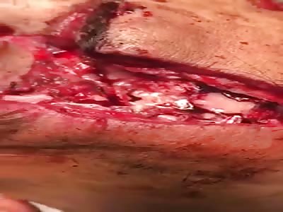 Brutal head injurys after machete attack