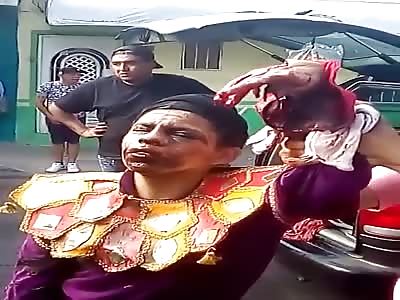 Shotgun Accident Leaves Hand Looking Like Hamburger