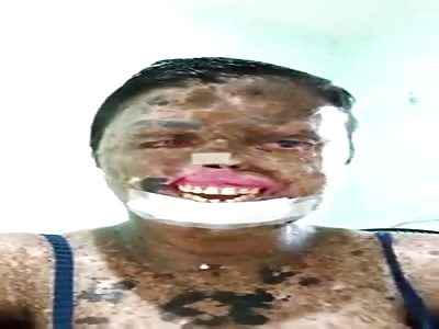 A Burn Victim Says Hello