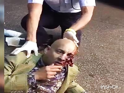 Man With a Hole in the Face Just wants to Smoke  a Cigarette