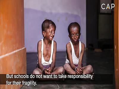 Two Indian brothers suffering from a rare and sad illness