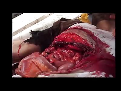 Shocking man with guts out wounded in war