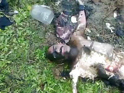 man has his whole body shattered and burned in the war