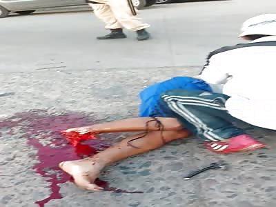 accIDENT MAN LOSES HIS FOOT