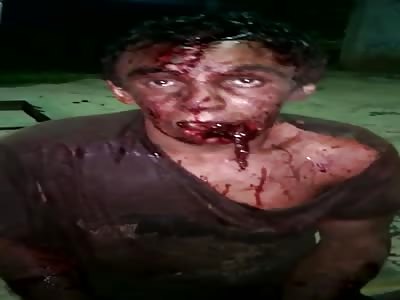 Horrible Pitbull Attack Leaves Thief with Shredded Mouth