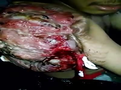 man with a terrible tumor on his body