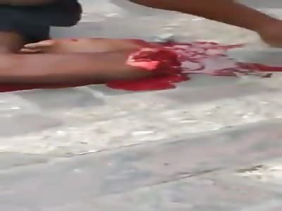 leg destroyed in accident