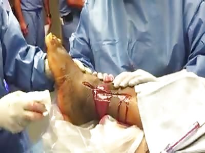 Elimination of a large 