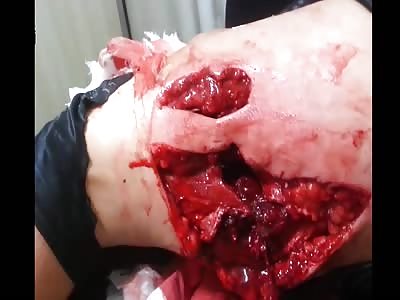 Severely Blasted And Ripped Leg