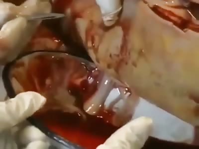 Patient, male, 23 years old, subjected to abscess drainage after spider bite.