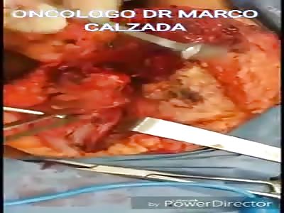 fragmented bullet wound 