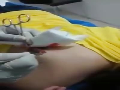 Tattoo cure with severe infection