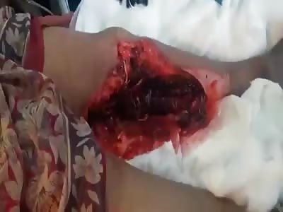 Lady has a nasty gash.