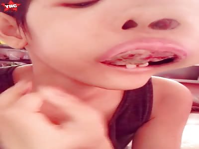 Sad - young woman has facial tumor