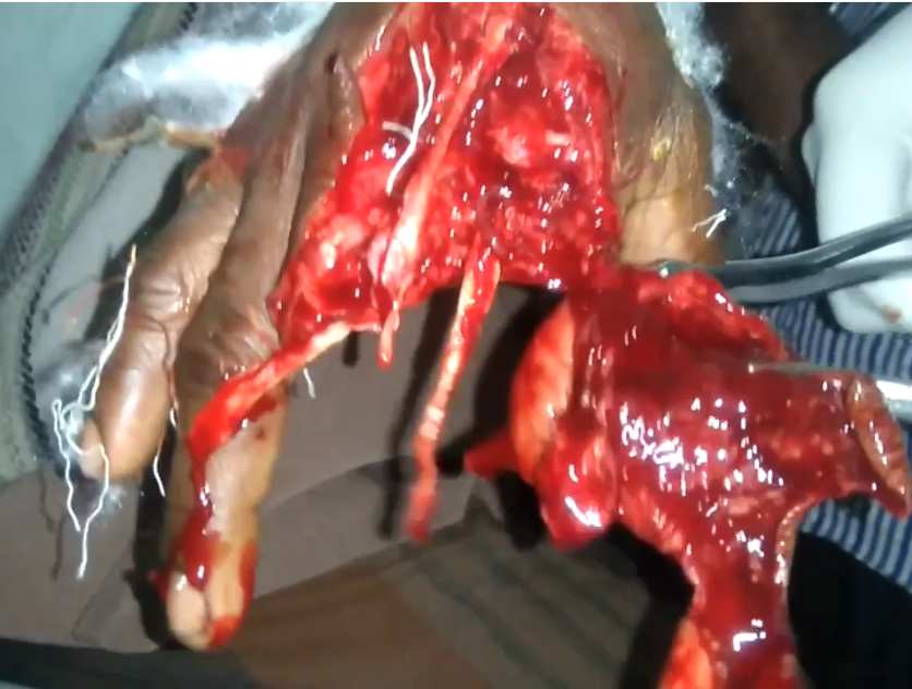 Man In Absolute Agony With Horrific Injury Gets Part of Hand Cut off