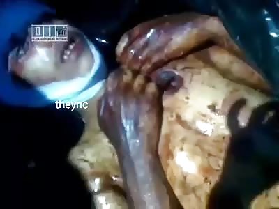 boy with severe burns