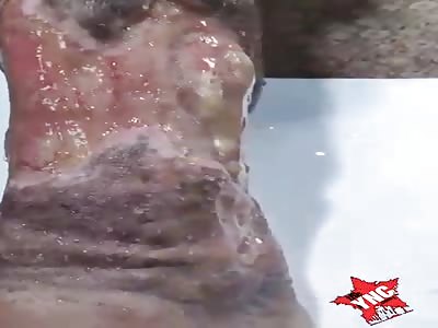 Foot seriously injured from burns