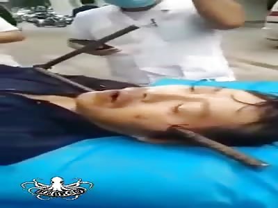 metal bar, embedded in the face