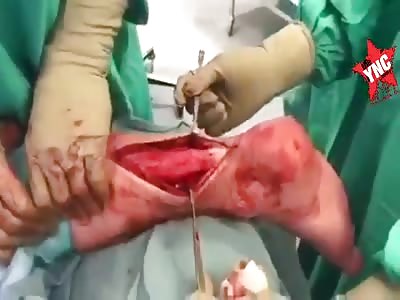 Ouch, Achilles tendon evaluation after surgical repair for rupture