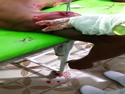 extract a rubber bullet from his arm