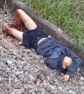 FAILED SUICIDE: Still Alive with Both Legs Cut off