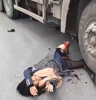 Looking at What's Left of Her Leg