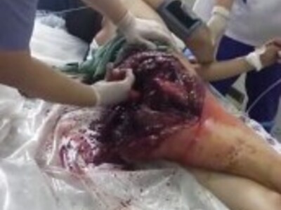 Girls Ass Exploded from Butt Implants