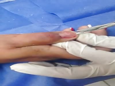 EWWW Removing a Nail