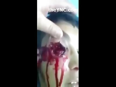 Kid Stabbed in the Eye Aftermath in the Emergency Room 