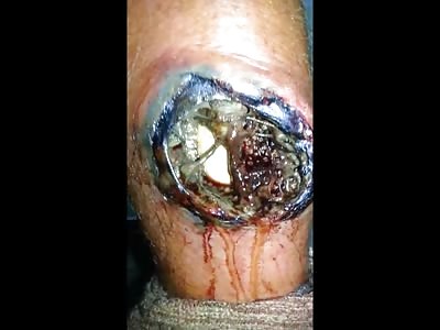 Nasty Infection Infested with Maggots.....Disgusting