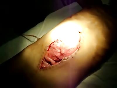 DISGUSTING Open Abdomen Wound