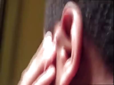 Popping Pus and It Pours Out