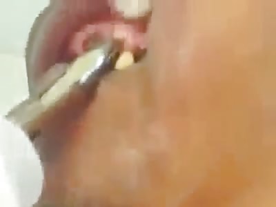 Teeth Pulled Out, Then Gross Ensues!!